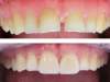 veneer before and after_2
